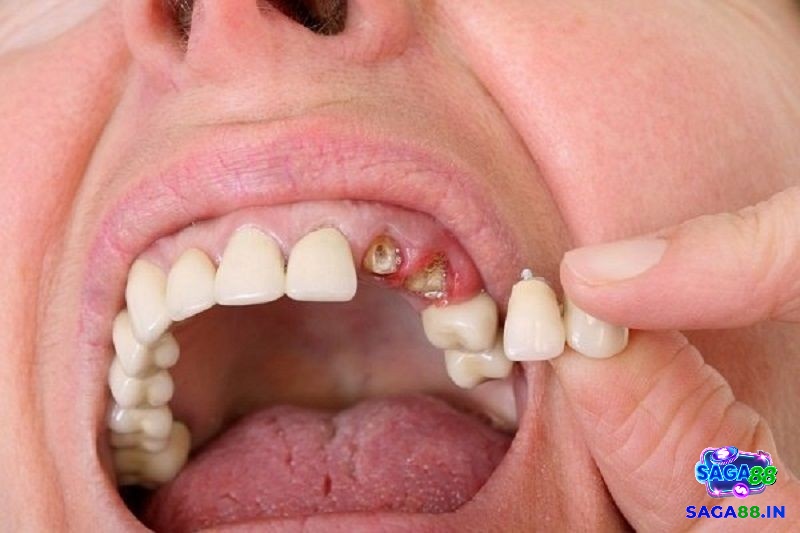 Giải mã giấc mơ thấy rụng răng chảy máu về ý nghĩa tâm linh